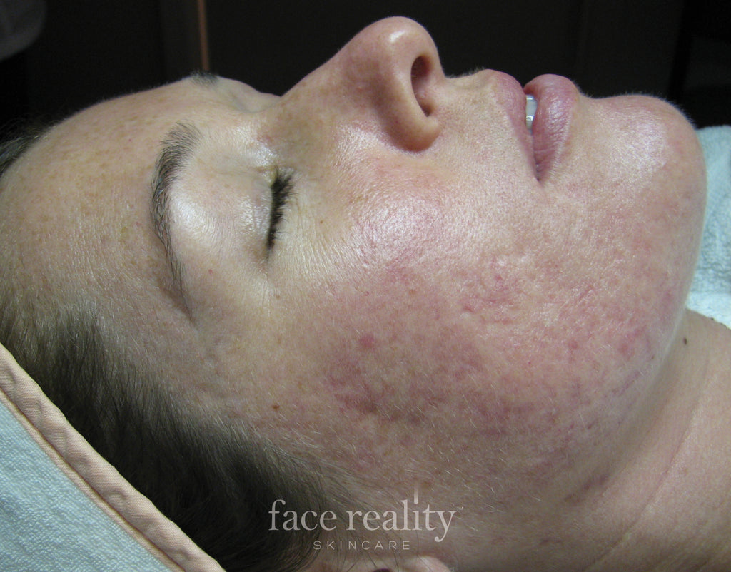 Face Reality 5% Acne Med