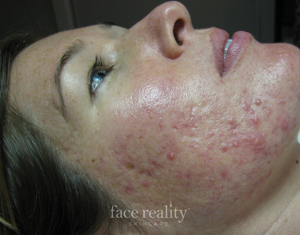 Face Reality 5% Acne Med