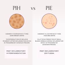 PIH v PIE